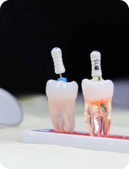 Dévitalisation : les bons réflexes avant et après le traitement
