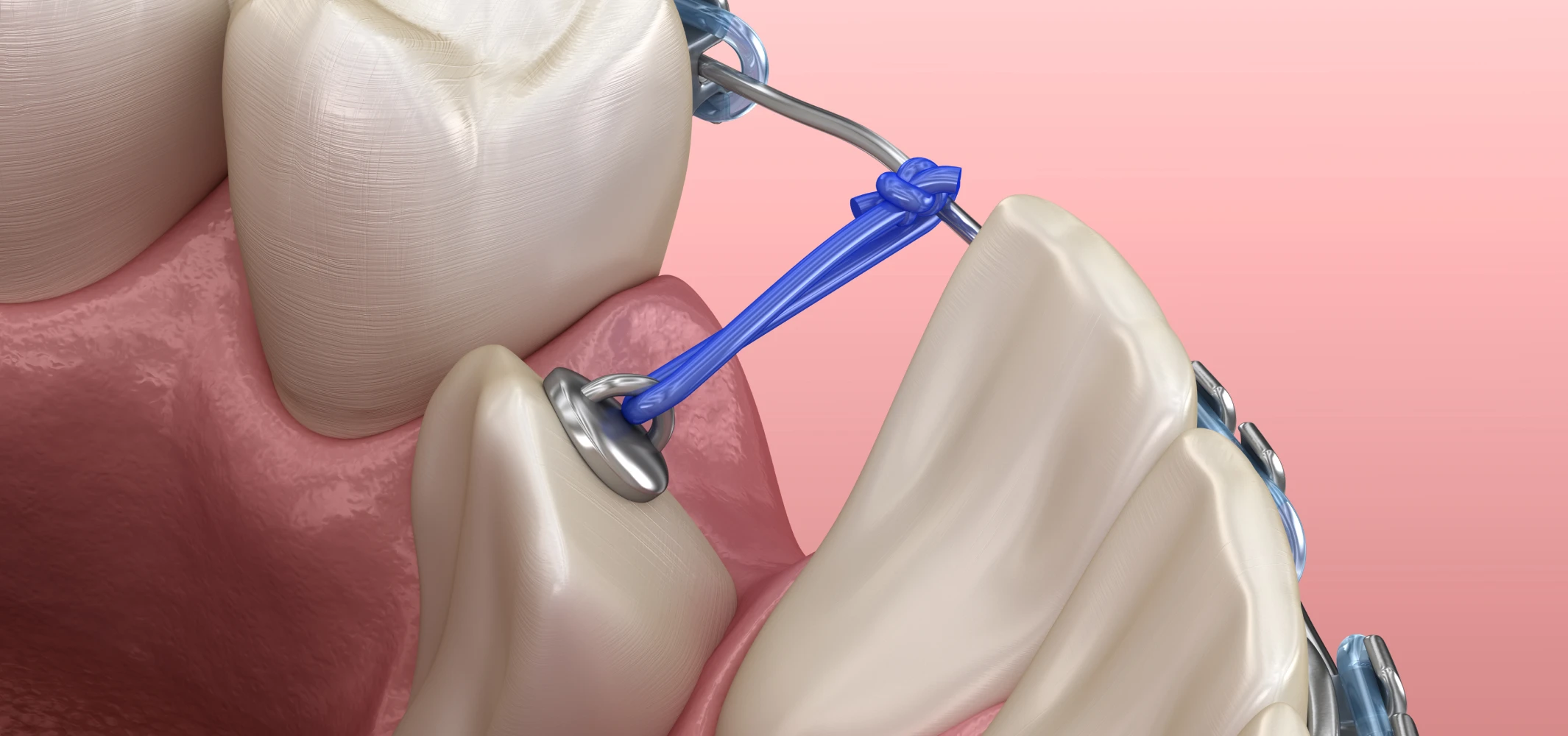 Dégagement des dents incluses