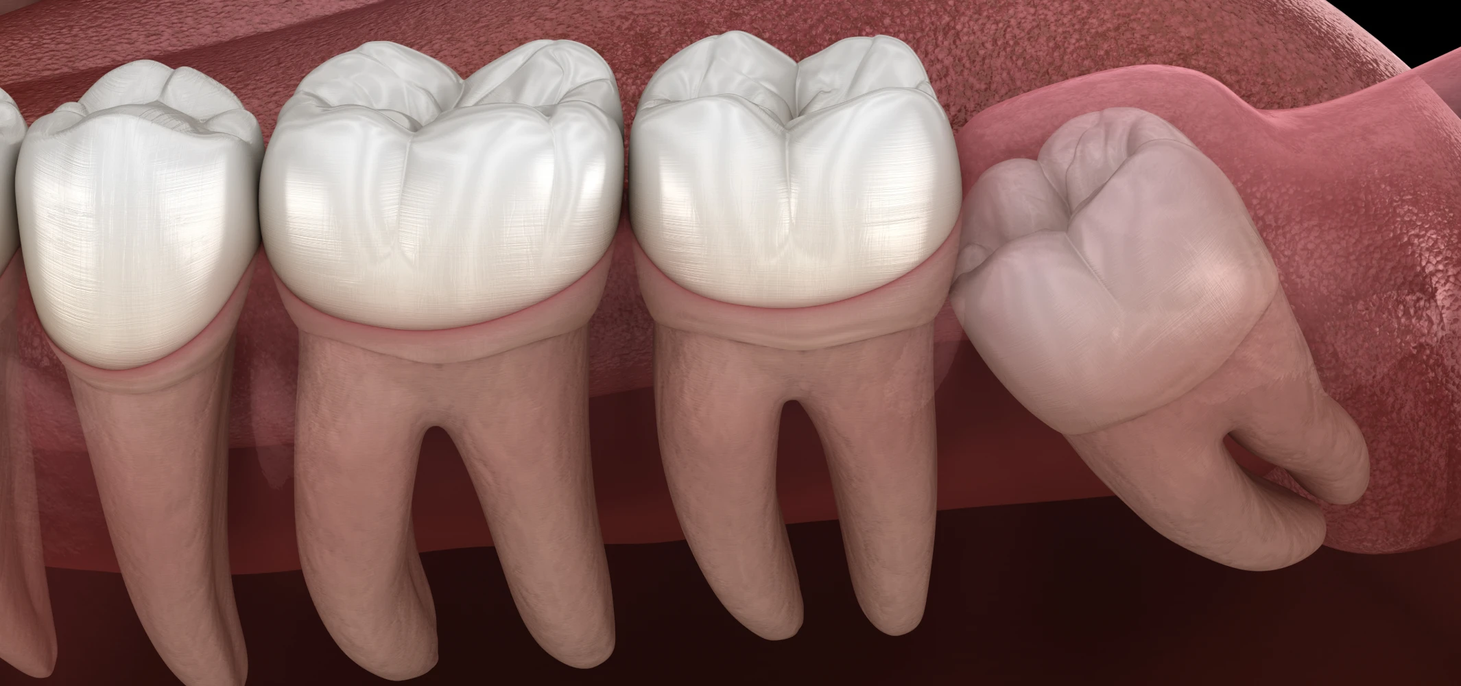 Dégagement des dents incluses