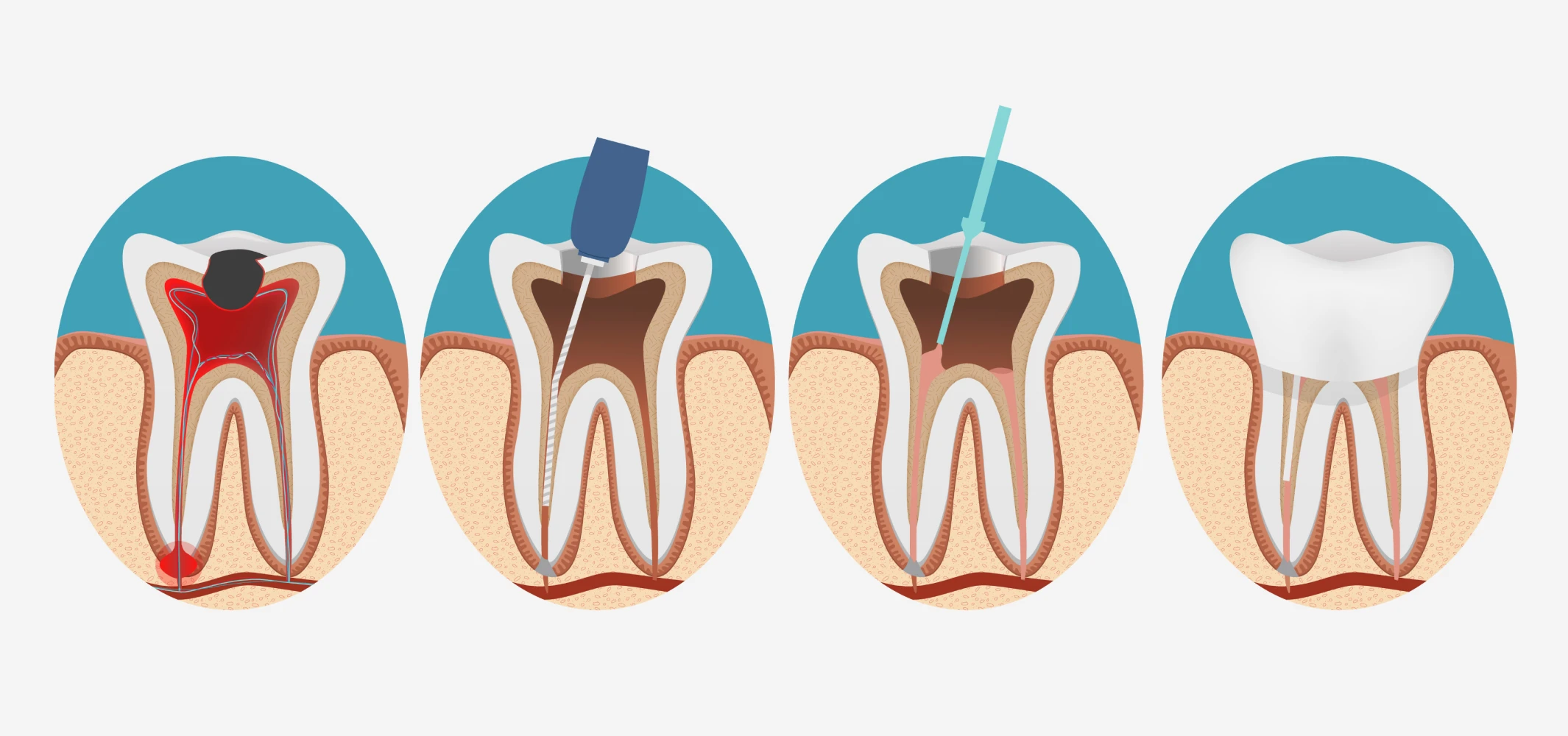 Dévitalisation