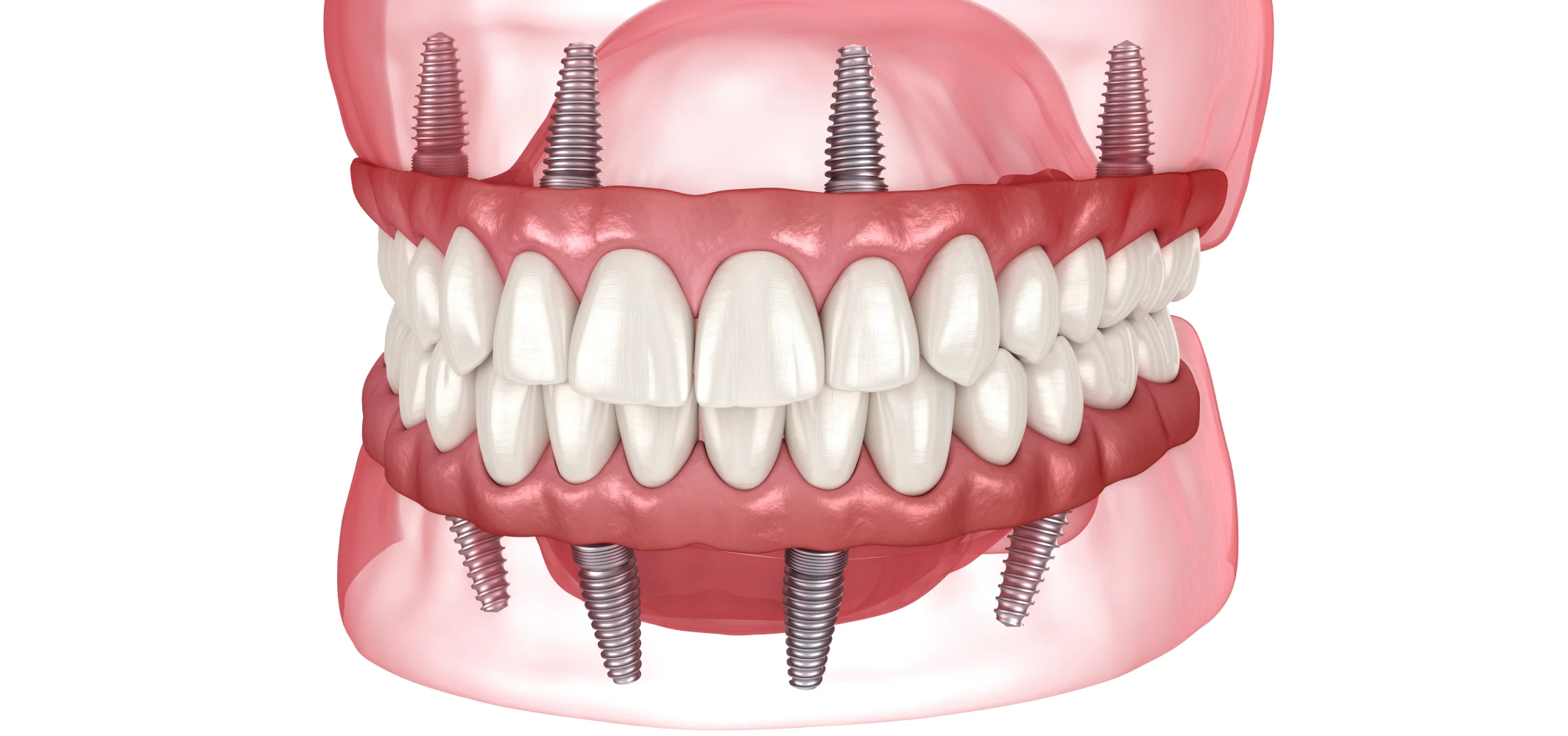 Remplacement de plusieurs dents