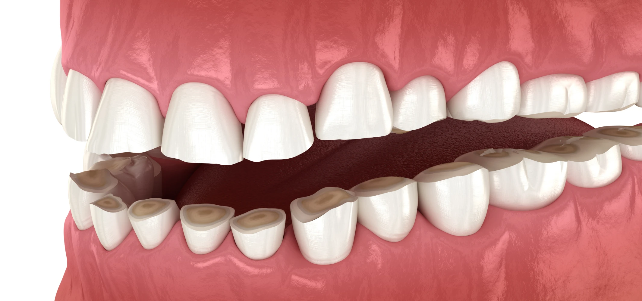 Usure des dents