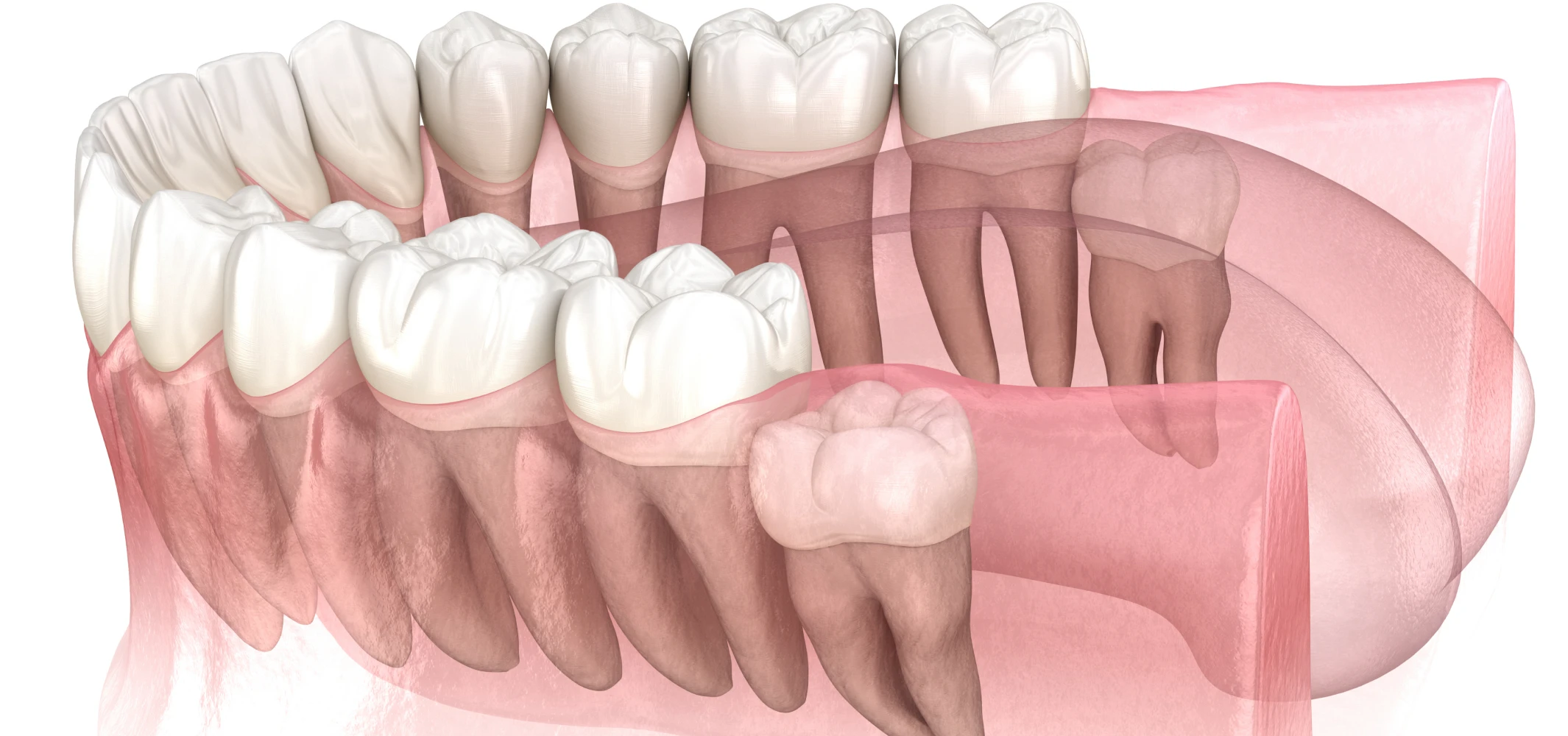 Dents de sagesse