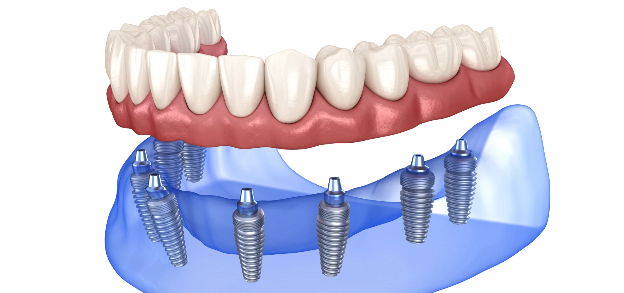 Prothèse complète sur implants